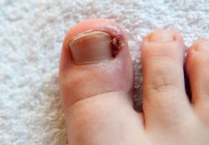 A person with toenail fungus on their toe.