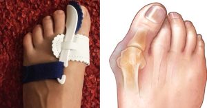 A person with an artificial toe is shown next to an image of the foot.